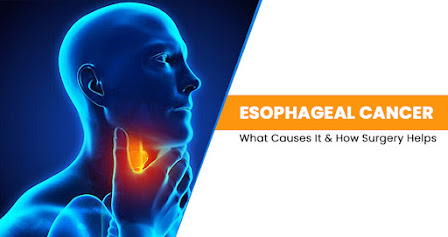 Esophageal Cancer: What Causes It & How Surgery Helps